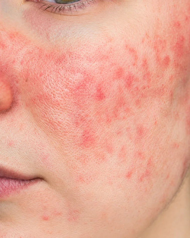 Before using redness-focused skincare
