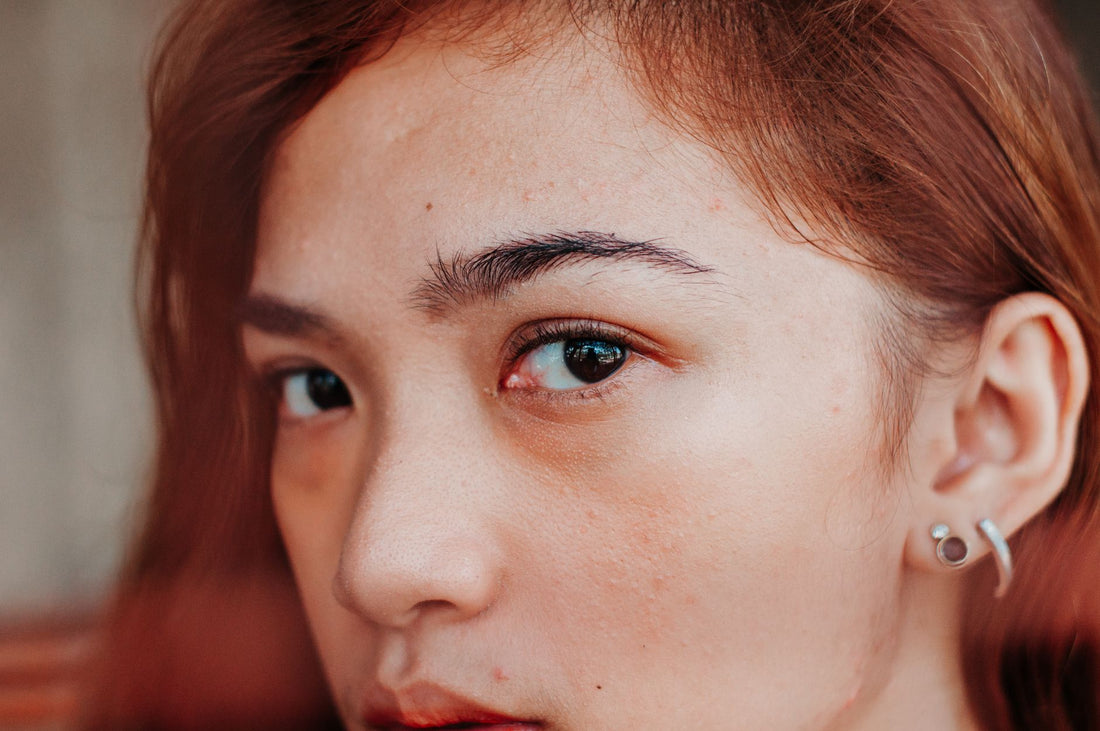 What Is the Best Treatment for a Rosacea Flare-Up?
