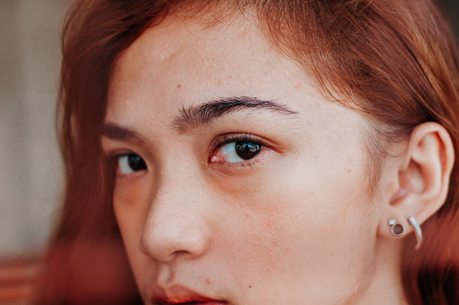 What Is the Best Treatment for a Rosacea Flare-Up?