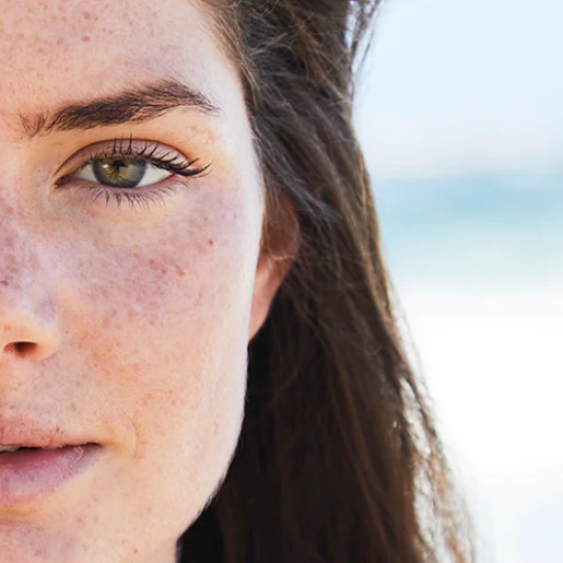 Sunspots or Melanoma: Everyone’s at Risk, So How Can You Prevent It?