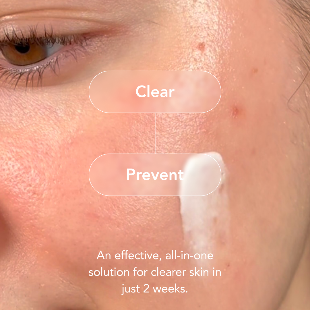 90-Day Acne Kit