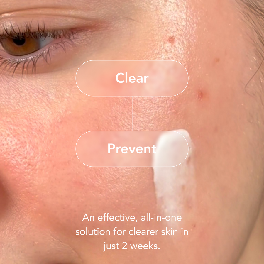 90-Day Acne Kit