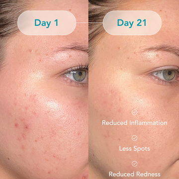 Comprehensive Acne Treatment