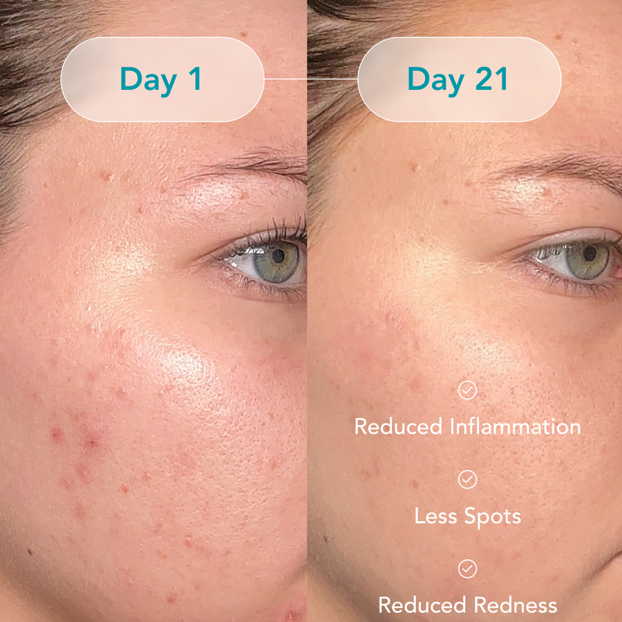 90-Day Acne Kit