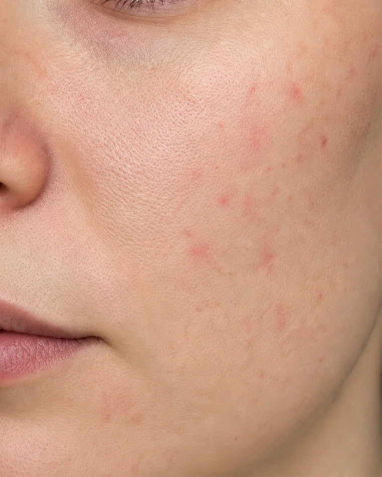 After using redness-focused skincare