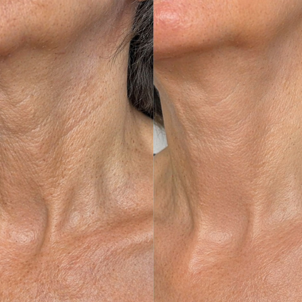 Before and after neck skin transformation for Lucy Tilgner