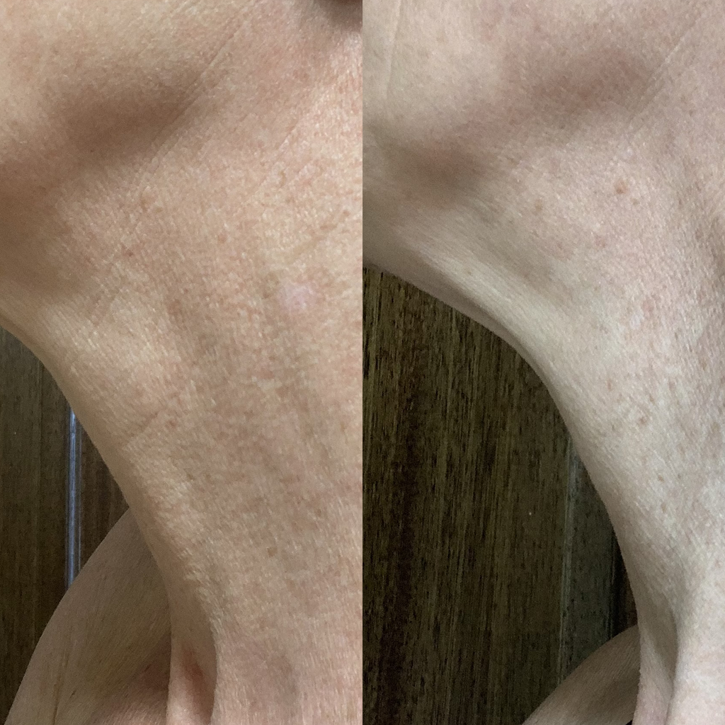 Before and after neck skin transformation for Cheryl Brignell