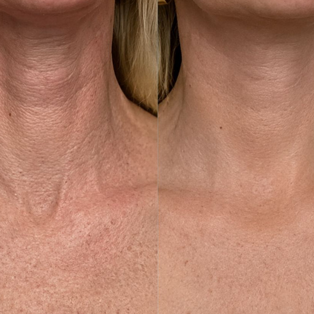 Before and after neck skin transformation for Patricia Moore