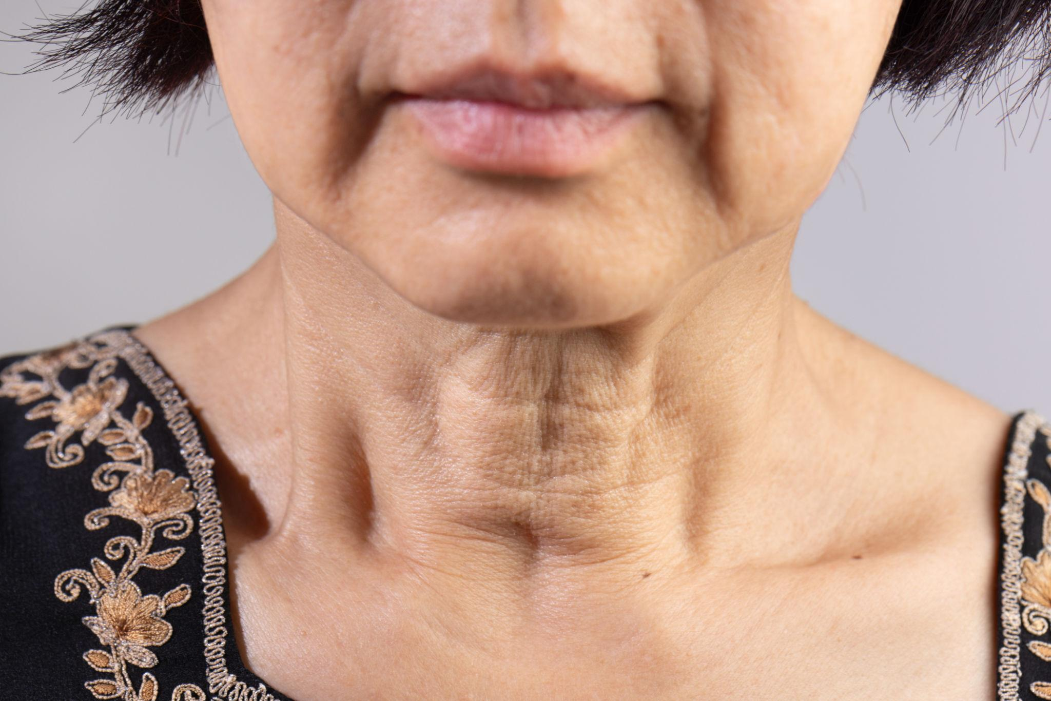 Loss of elasticity along the neck and jawline