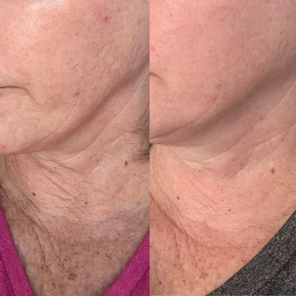 Collagen depletion and deepening neck lines