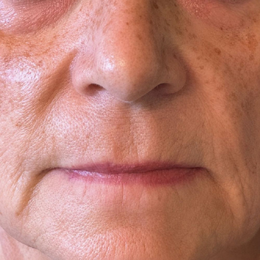 Before — deep wrinkles and age spots, baseline