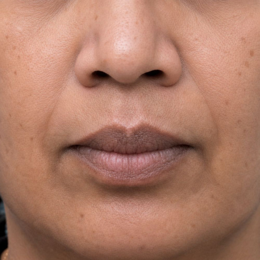 After 9 weeks of use — more even tone, hyperpigmentation reduced