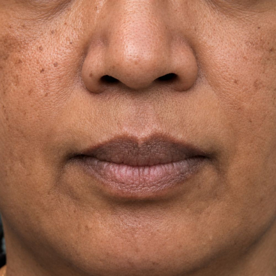 Before — hyperpigmentation and uneven tone, baseline