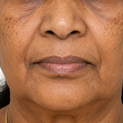 Before — fine lines and sun pigmentation, baseline