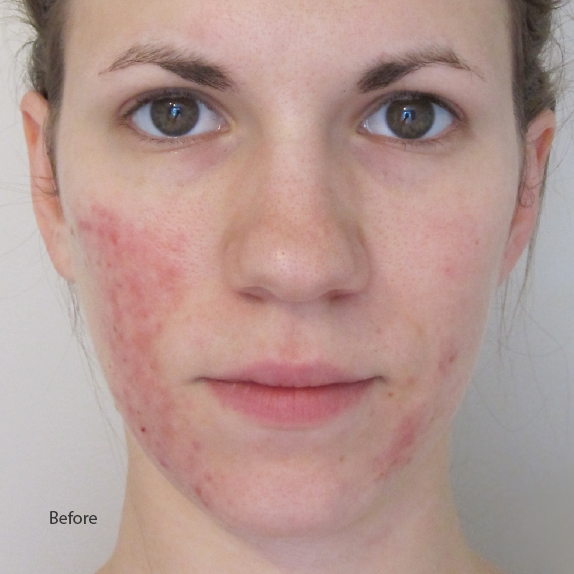Riversol Redness Control Skincare Kit for Rosacea Prone Skin - Reduce ...